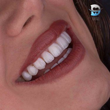 لبخند زیبا و دلنشین بعد از کامپوزیت دندان در کلینیک دُرّین