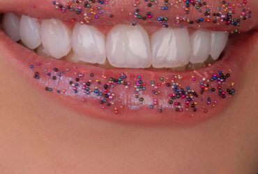 لبخند زیبا بعد از کامپوزیت در کلینیک دندانپزشکی دُرّین، شیراز