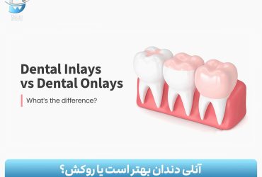 آنلی دندان بهتر است یا روکش؟ بررسی کامل مزایا، معایب و تفاوتها