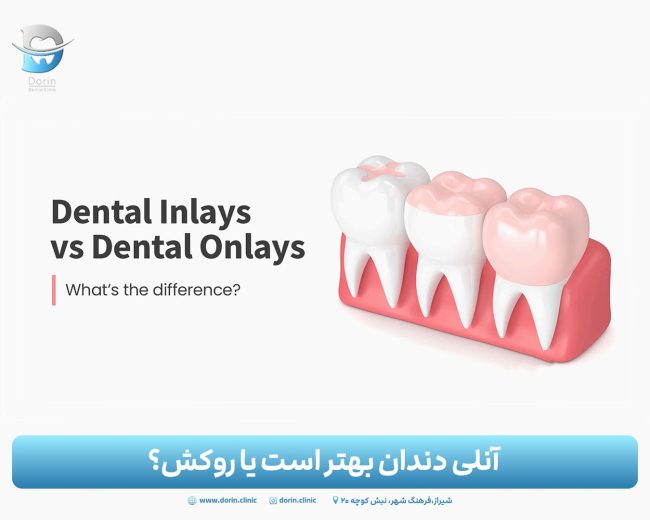 آنلی دندان بهتر است یا روکش؟ بررسی کامل مزایا، معایب و تفاوت‌ها