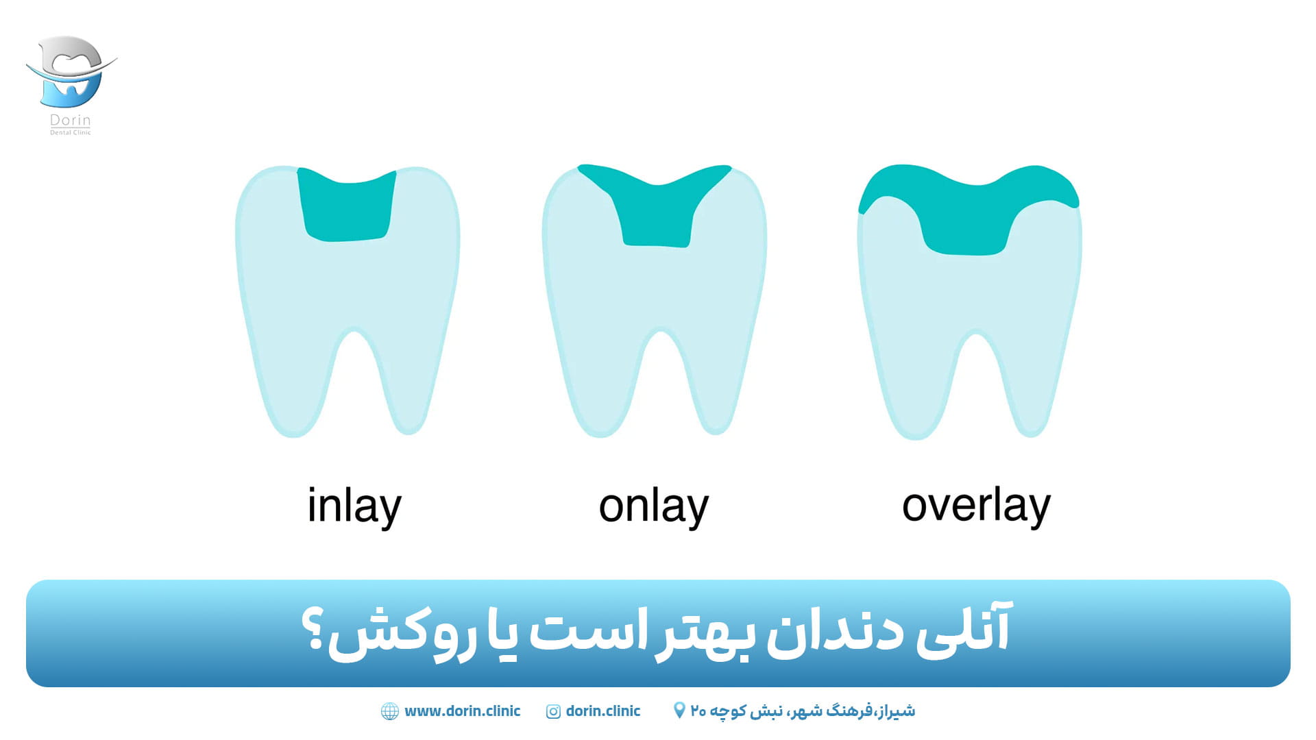 آنلی دندان بهتر است یا روکش؟